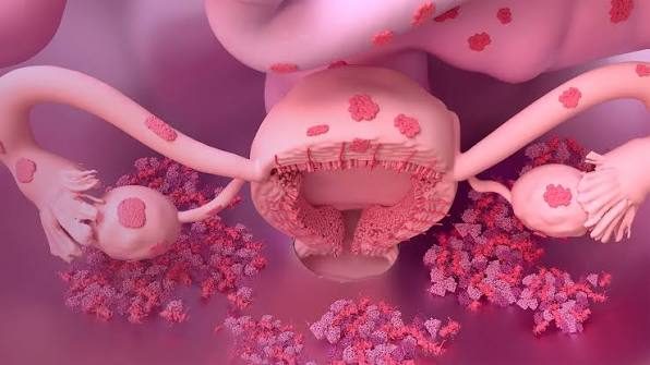 Endometriosis treatment in Jaipur